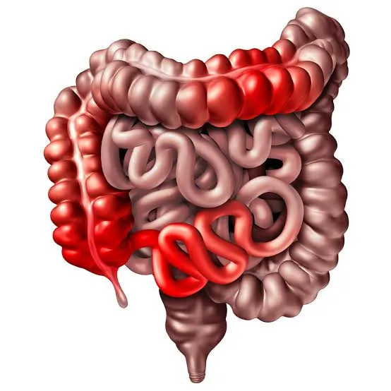 بیماری کرون (Crohn)