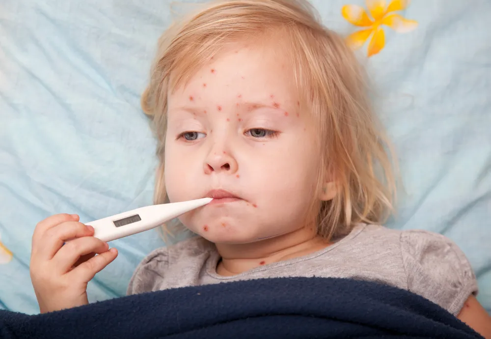 سرخجه (Rubella)