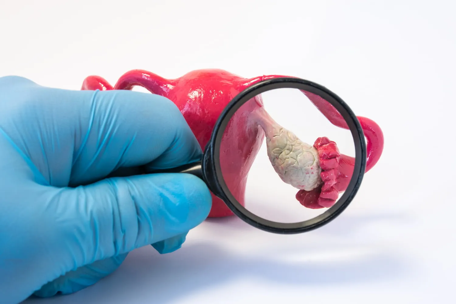 سندرم تخمدان پلی‌کیستیک (PCOS)