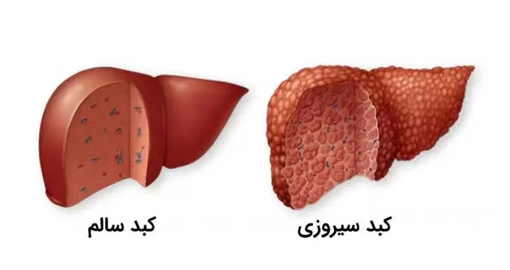 سیروز کبدی